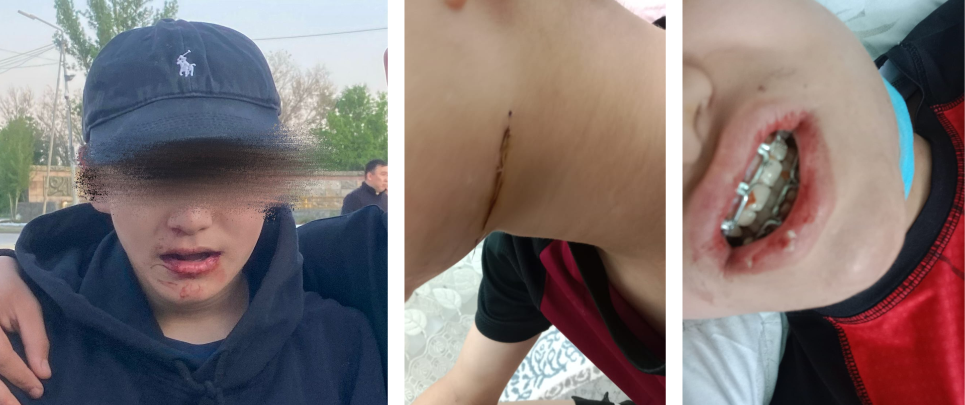 Прыгали на голове: школьнику во время разборок в Хромтау сломали челюсть